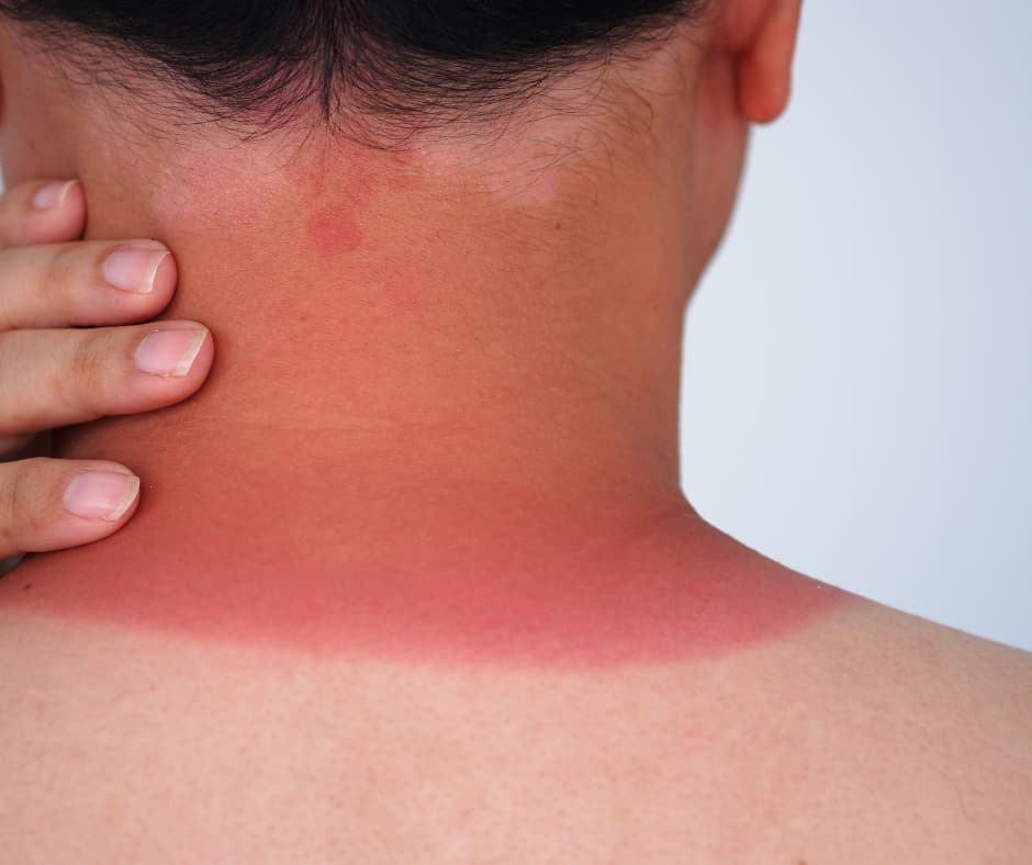 coup de soleil brûlure soin infirmier